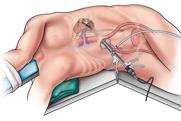 Lap Adrenalectomy