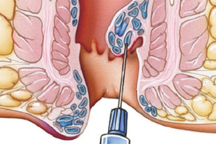 Laser Anorectal Surgery