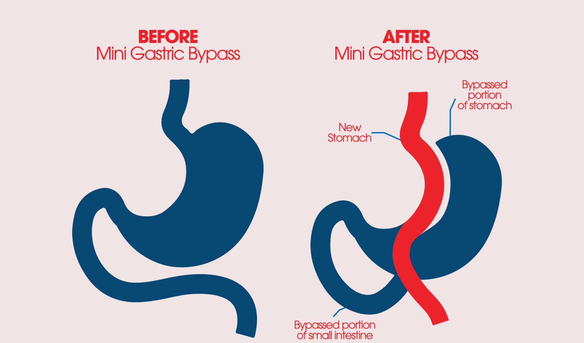 Mini Gastric Bypass (OAGB)