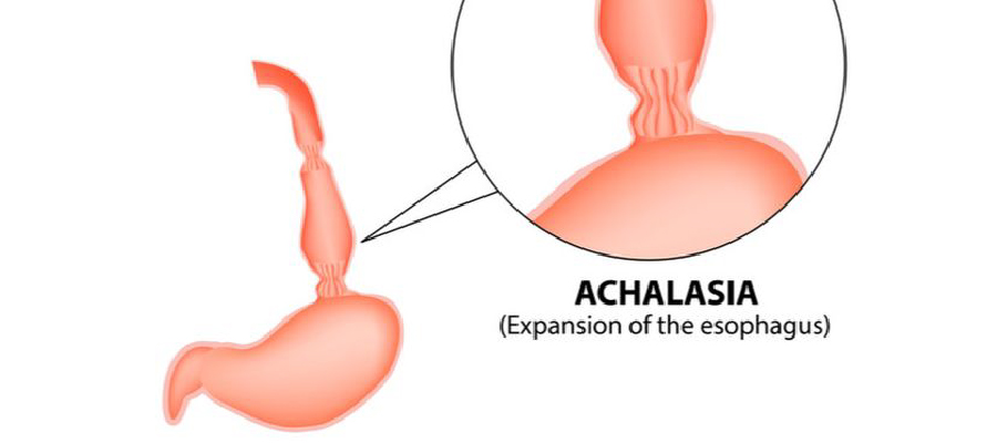 Lap Achalasia Cardia