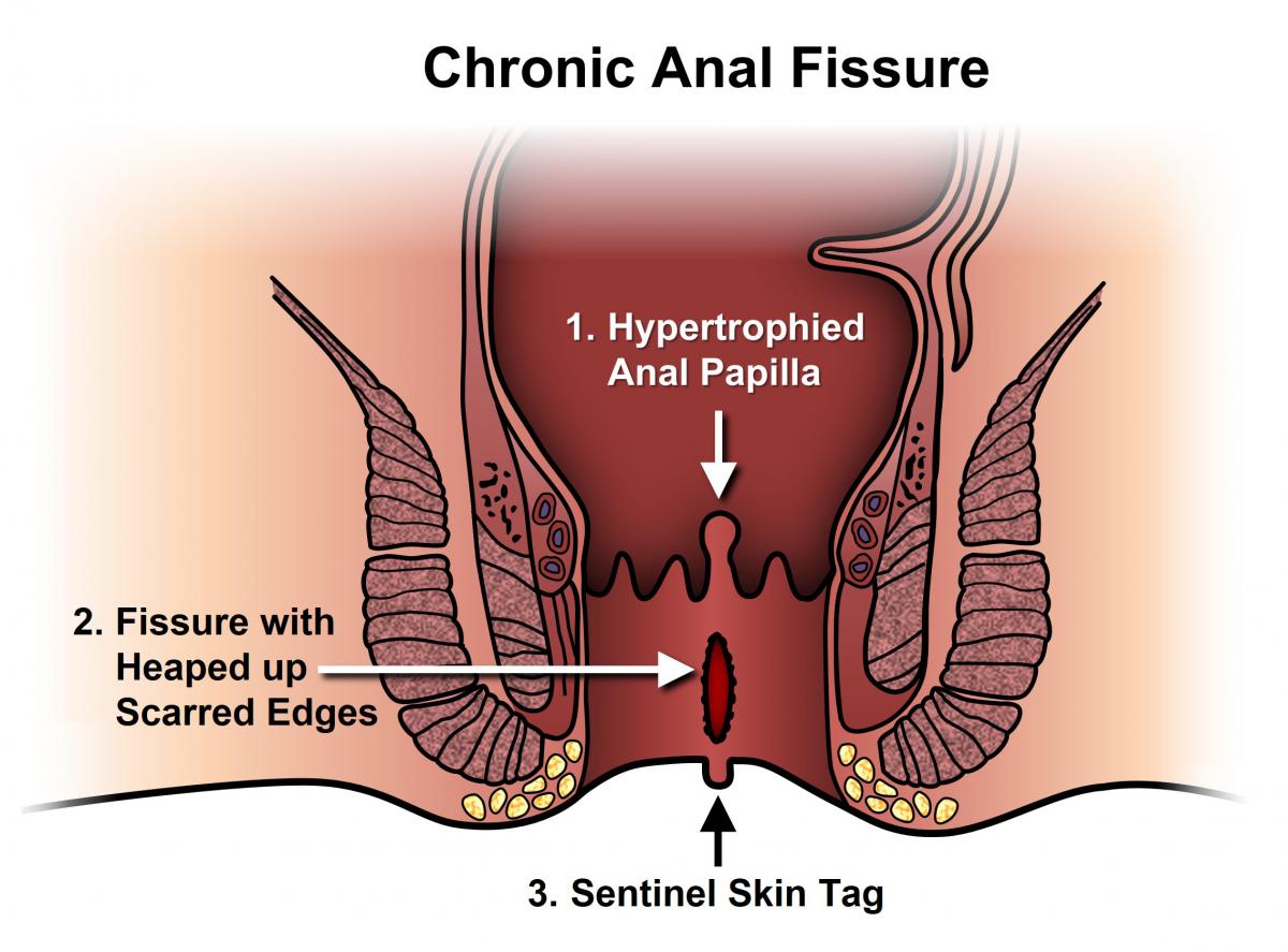Anal Fissure