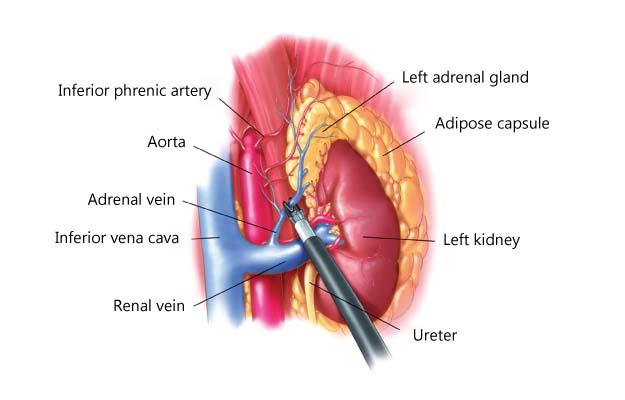 Lap Adrenalectomy