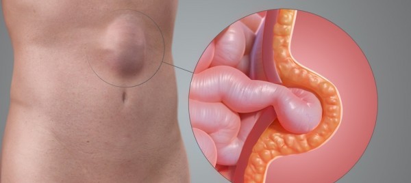 Lap Ventral/ Incisional Hernia Surgery
