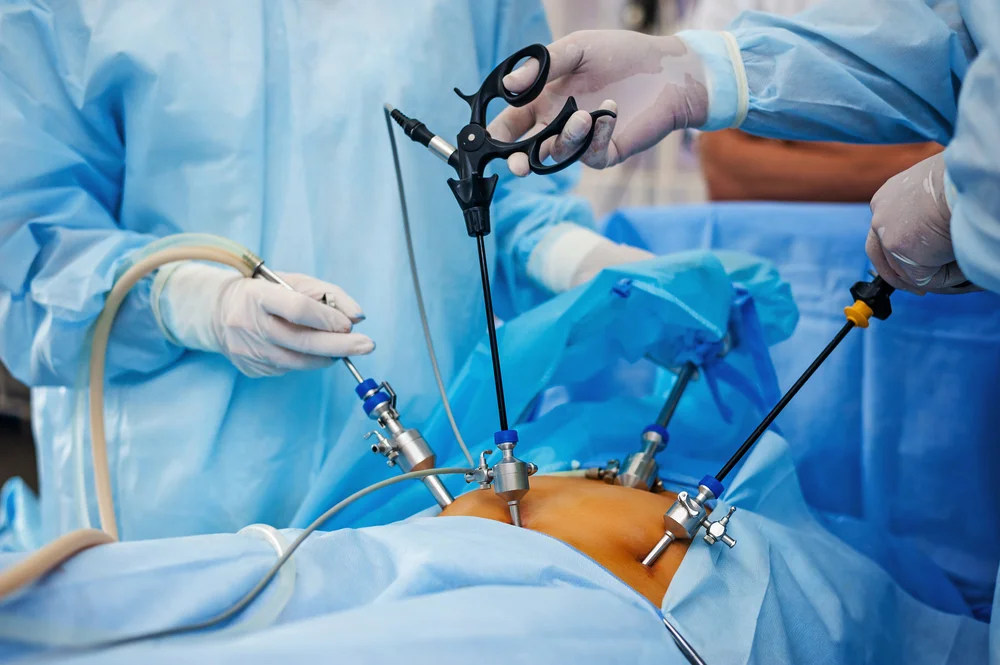 Laparoscopic Gastrointestinal (GI) Surgery