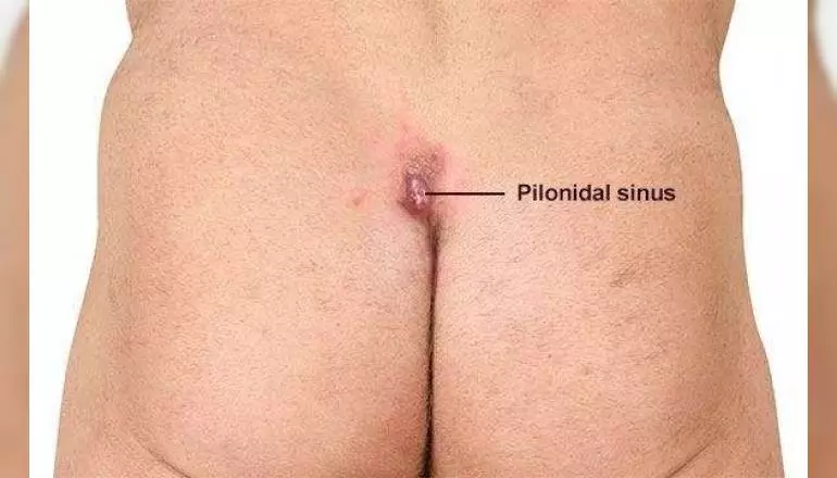 Pilonidal Sinus