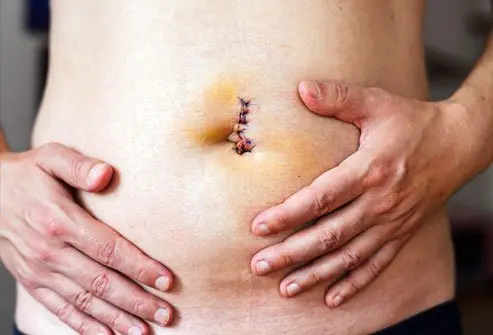 umbilical hernia Surgery